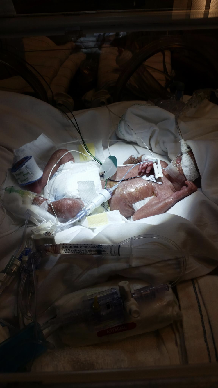 I had my son at 23 weeks gestation and he only weighted 1.3 lb , he was in the NICU for 6 months, doctors were telling me that he only had a 20% of possibility that my son could make it, it was very difficult moments because every day was a New day for my son, he had a heart surgery when he was in the nicu he was only one month old During the surgery my son started to lose he’s pulse they were trying to bring him back a life, and thank God, nurses and doctors my son recovered, I’m very thankful with all the NICU hero’s Dr and nurses did the best for my son and now he’s here 5 year now he’s doing great.

