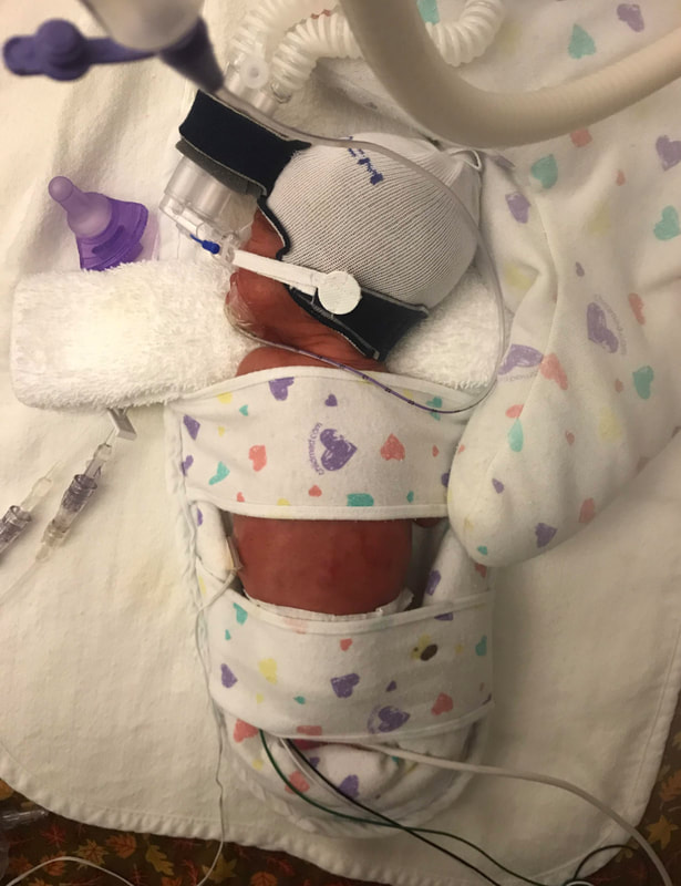 Our little peanut came early at 27.5 weeks d/t Hellp syndrome. Weighing 1lbs 13 oz. the amount of worry was unimaginable. We had a great team at UC Nicu we done 97 days before getting released. The staff became family more so. The lactation department was amazing as well. The amount of compassion given to us will never be forgotten. Until a parent sits in the NICU watching their child fight for their life they just don’t understand but nicu family does we’ve all been there. I’ll always be grateful for everything they done to help make our stay manageable. It’s amazing how far they come so fast. It’s like yesterday I was wondering the outcome of everything and here we are today he’s 20 months 17 corrected and happy and healthy as can be!
